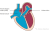 Een ASD is een aangeboren opening in het tussenschot van de boezems in het hart